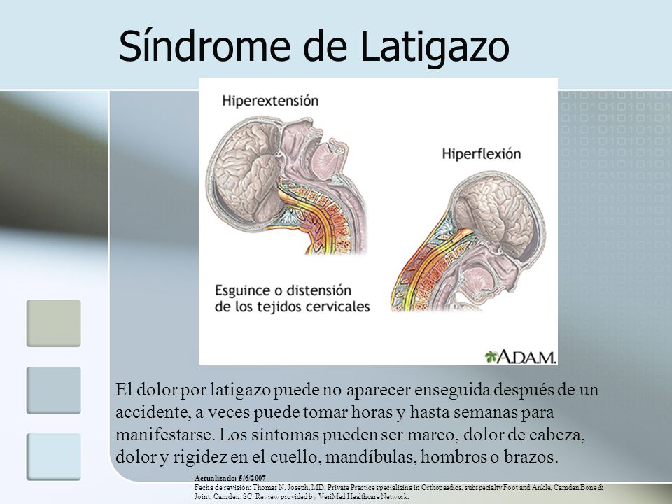 que es el sindrome del latigazo